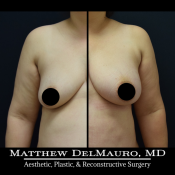 NYC-Before-After-3.5-Months-Lipoabdominoplasty-Fat-Grafting-to-Bilateral-Breasts1