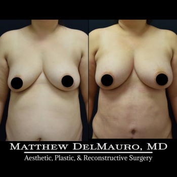 NYC-Before-After-3.5-Months-Lipoabdominoplasty-Fat-Grafting-to-Bilateral-Breasts2