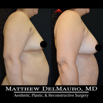 NYC-Before-After-3.5-Months-Lipoabdominoplasty-Fat-Grafting-to-Bilateral-Breasts3