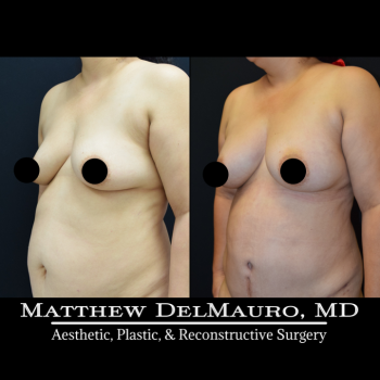 NYC-Before-After-3.5-Months-Lipoabdominoplasty-Fat-Grafting-to-Bilateral-Breasts4