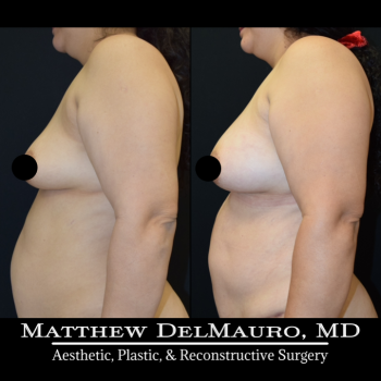 NYC-Before-After-3.5-Months-Lipoabdominoplasty-Fat-Grafting-to-Bilateral-Breasts5