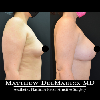 NYC-Before-After-4-Months-Lipo360-Liposuction-of-Bilateral-Upper-Arms-Fat-Grafting-To-Bilateral-Breasts-and-Lower-Abdomen-Bilateral-Breast-Augmentation-Silicone2