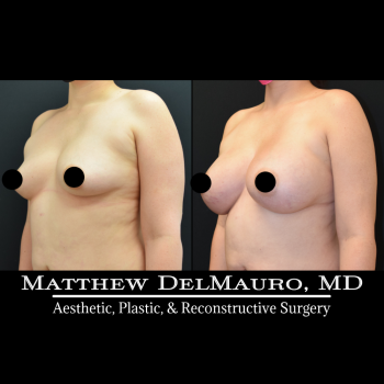NYC-Before-After-4-Months-Lipo360-Liposuction-of-Bilateral-Upper-Arms-Fat-Grafting-To-Bilateral-Breasts-and-Lower-Abdomen-Bilateral-Breast-Augmentation-Silicone3