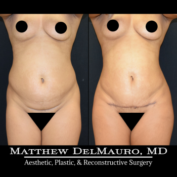 NYC-Before-After-3.75-Months-Liposuction-of-Abdomen-Waist-Flanks-Abdominal-Scar-Revision-Fat-Grafting-to-Bilateral-Hips2