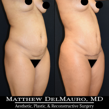 NYC-Before-After-3.75-Months-Liposuction-of-Abdomen-Waist-Flanks-Abdominal-Scar-Revision-Fat-Grafting-to-Bilateral-Hips3