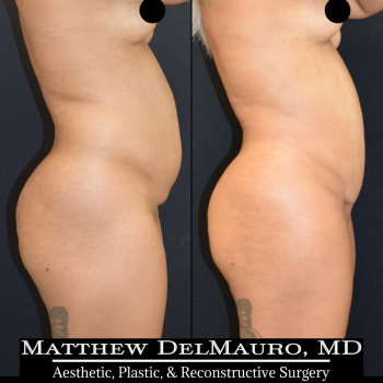 NYC-Before-After-3.75-Months-Liposuction-of-Abdomen-Waist-Flanks-Abdominal-Scar-Revision-Fat-Grafting-to-Bilateral-Hips4