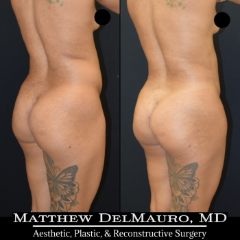NYC-Before-After-3.75-Months-Liposuction-of-Abdomen-Waist-Flanks-Abdominal-Scar-Revision-Fat-Grafting-to-Bilateral-Hips5