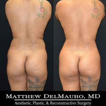 NYC-Before-After-3.75-Months-Liposuction-of-Abdomen-Waist-Flanks-Abdominal-Scar-Revision-Fat-Grafting-to-Bilateral-Hips6