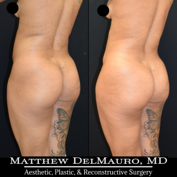 NYC-Before-After-3.75-Months-Liposuction-of-Abdomen-Waist-Flanks-Abdominal-Scar-Revision-Fat-Grafting-to-Bilateral-Hips7
