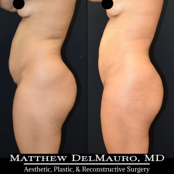NYC-Before-After-3.75-Months-Liposuction-of-Abdomen-Waist-Flanks-Abdominal-Scar-Revision-Fat-Grafting-to-Bilateral-Hips8