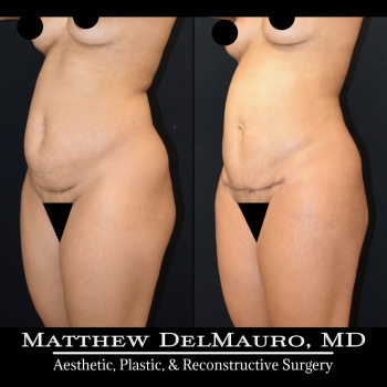 NYC-Before-After-3.75-Months-Liposuction-of-Abdomen-Waist-Flanks-Abdominal-Scar-Revision-Fat-Grafting-to-Bilateral-Hips9