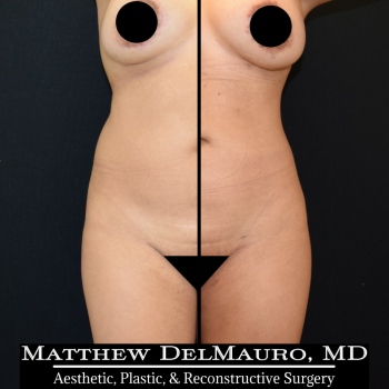 NYC-Before-After-1-Years-1-Months-Lipo360-1