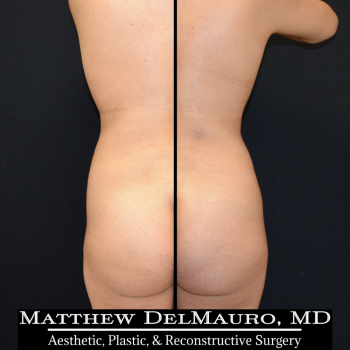 NYC-Before-After-1-Years-1-Months-Lipo360-2