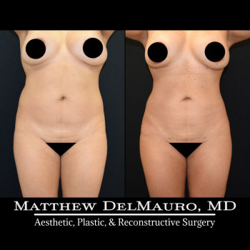 NYC-Before-After-1-Years-1-Months-Lipo360-3