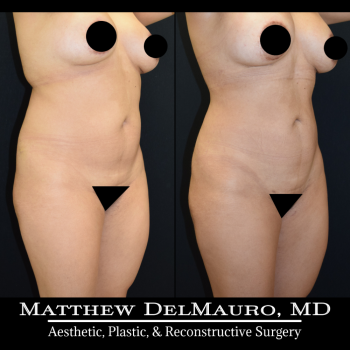 NYC-Before-After-1-Years-1-Months-Lipo360-4