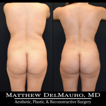 NYC-Before-After-1-Years-1-Months-Lipo360-6