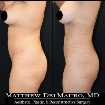 NYC-Before-After-1-Years-1-Months-Lipo360-7