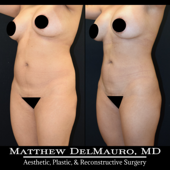 NYC-Before-After-1-Years-1-Months-Lipo360-8