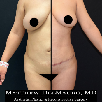 NYC-Before-After-3-Months-Tummy-Tuck-Tune-Up-Lipo360-1