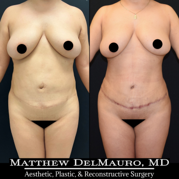 NYC-Before-After-3-Months-Tummy-Tuck-Tune-Up-Lipo360-2