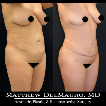 NYC-Before-After-3-Months-Tummy-Tuck-Tune-Up-Lipo360-3