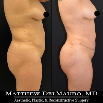 NYC-Before-After-3-Months-Tummy-Tuck-Tune-Up-Lipo360-4