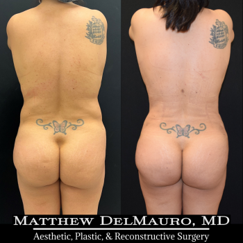NYC-Before-After-3-Months-Tummy-Tuck-Tune-Up-Lipo360-5