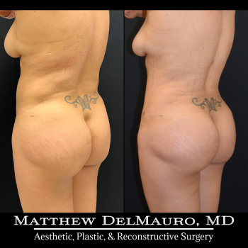NYC-Before-After-3-Months-Tummy-Tuck-Tune-Up-Lipo360-6