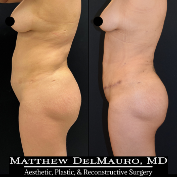 NYC-Before-After-3-Months-Tummy-Tuck-Tune-Up-Lipo360-7