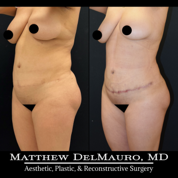 NYC-Before-After-3-Months-Tummy-Tuck-Tune-Up-Lipo360-8