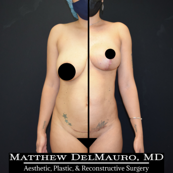 NYC-Before-After-3.5-Months-Breast-Lift-Liposuction-of-the-Abdomen-Flanks-Abdominal-Scar-Revision1