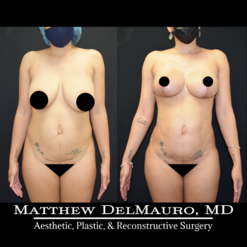 NYC-Before-After-3.5-Months-Breast-Lift-Liposuction-of-the-Abdomen-Flanks-Abdominal-Scar-Revision3