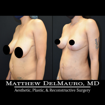 NYC-Before-After-3.5-Months-Breast-Lift-Liposuction-of-the-Abdomen-Flanks-Abdominal-Scar-Revision4