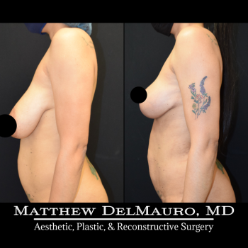 NYC-Before-After-3.5-Months-Breast-Lift-Liposuction-of-the-Abdomen-Flanks-Abdominal-Scar-Revision5