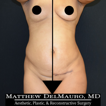 liposuction before and after gallery