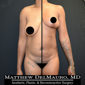 NYC-Before-After-4-Months-Breast-Lift-Liposuction-of-Abdomen1