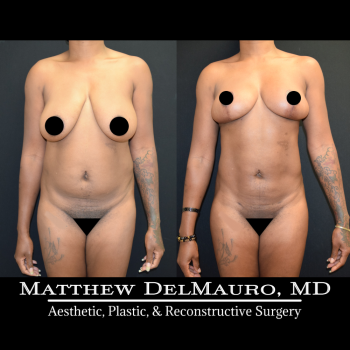 NYC-Before-After-4-Months-Breast-Lift-Liposuction-of-Abdomen3