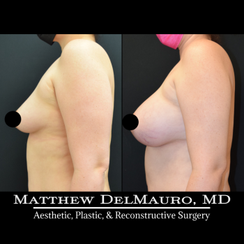 NYC-Before-After-4-Months-Lipo360-Liposuction-of-Bilateral-Upper-Arms-Fat-Grafting-To-Bilateral-Breasts-and-Lower-Abdomen-Bilateral-Breast-Augmentation-Silicone4