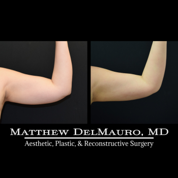 NYC-Before-After-4-Months-Lipo360-Liposuction-of-Bilateral-Upper-Arms-Fat-Grafting-To-Bilateral-Breasts-and-Lower-Abdomen-Bilateral-Breast-Augmentation-Siliconearms1