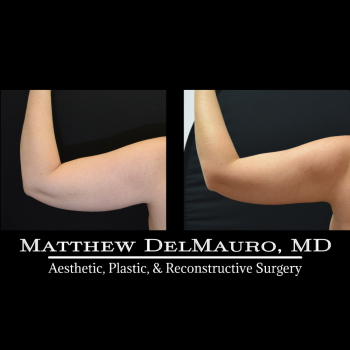 NYC-Before-After-4-Months-Lipo360-Liposuction-of-Bilateral-Upper-Arms-Fat-Grafting-To-Bilateral-Breasts-and-Lower-Abdomen-Bilateral-Breast-Augmentation-Siliconearms3
