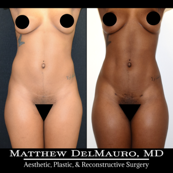 NYC-Before-After-6.5-Months-Abdominal-Liposuction2