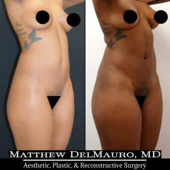 NYC-Before-After-6.5-Months-Abdominal-Liposuction3