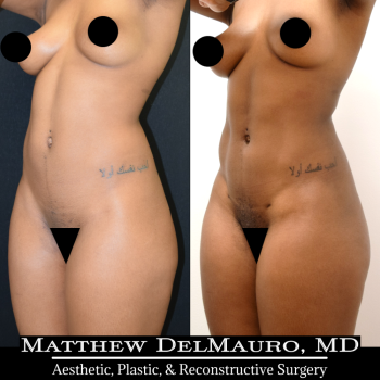 NYC-Before-After-6.5-Months-Abdominal-Liposuction4