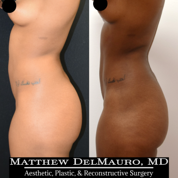 NYC-Before-After-6.5-Months-Abdominal-Liposuction5
