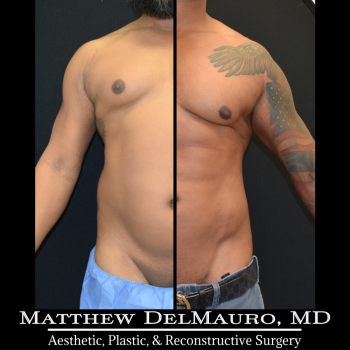 NYC-Before-After-6.5-Months-Lipo360-Liposuction-of-Chest-Fat-Grafting-to-Chest1