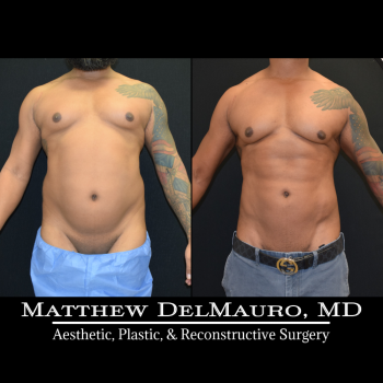 NYC-Before-After-6.5-Months-Lipo360-Liposuction-of-Chest-Fat-Grafting-to-Chest2
