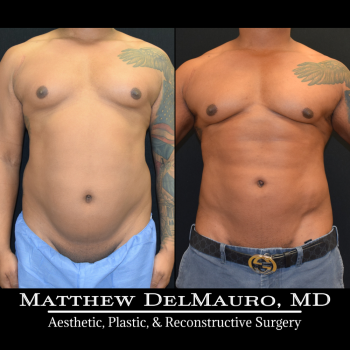 NYC-Before-After-6.5-Months-Lipo360-Liposuction-of-Chest-Fat-Grafting-to-Chest3