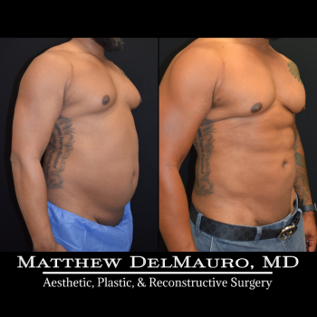 NYC-Before-After-6.5-Months-Lipo360-Liposuction-of-Chest-Fat-Grafting-to-Chest4