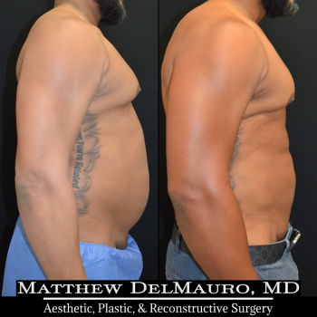 NYC-Before-After-6.5-Months-Lipo360-Liposuction-of-Chest-Fat-Grafting-to-Chest5