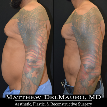NYC-Before-After-6.5-Months-Lipo360-Liposuction-of-Chest-Fat-Grafting-to-Chest6